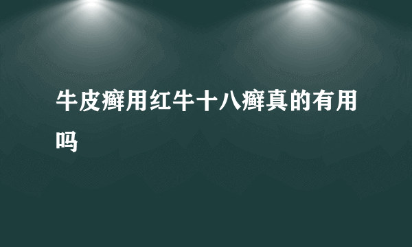 牛皮癣用红牛十八癣真的有用吗