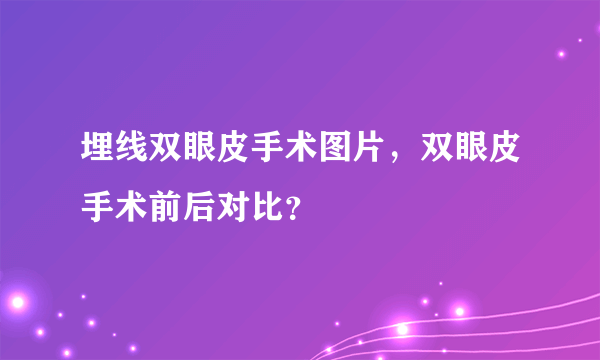 埋线双眼皮手术图片，双眼皮手术前后对比？