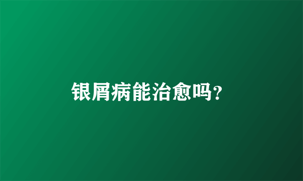 银屑病能治愈吗？