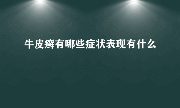 牛皮癣有哪些症状表现有什么