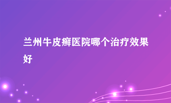 兰州牛皮癣医院哪个治疗效果好