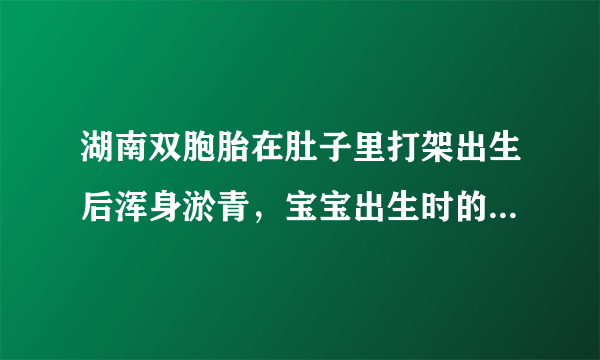 湖南双胞胎在肚子里打架出生后浑身淤青，宝宝出生时的淤青是怎样形成的？