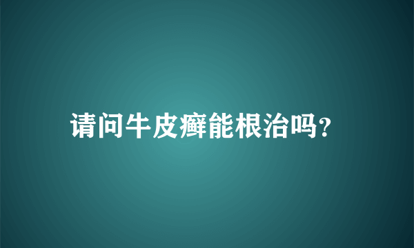 请问牛皮癣能根治吗？