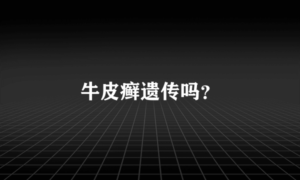 牛皮癣遗传吗？