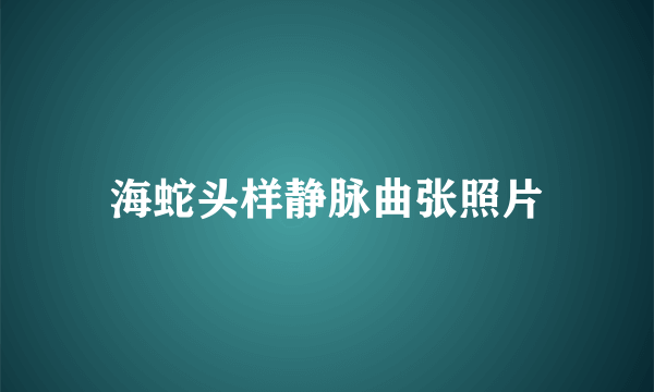 海蛇头样静脉曲张照片