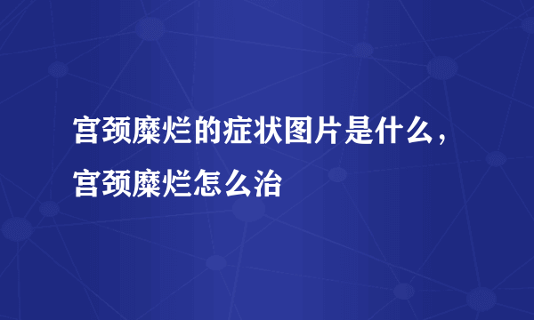 宫颈糜烂的症状图片是什么，宫颈糜烂怎么治